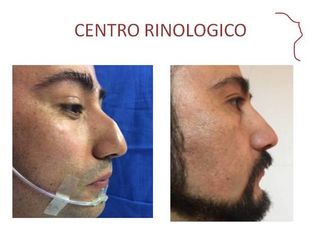 Antes y después de Rinoplastia secundaria