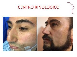 Antes y después de RINOPLASTIA SECUNDARIA.