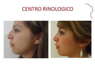 Antes y después de RINOPLASTIA POSTRAUMATICA