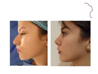 Antes y después de Rinoplastia (acortamiento nasal )