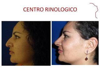 Antes y después de RINOSEPTOPLASTIA FUNCIONAL 