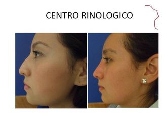 Antes y después de  RINOPLASTIA  