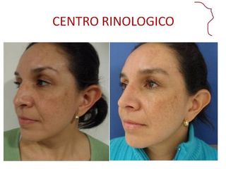 Antes y después de RINOPLASTIA POSTRAUMATICA