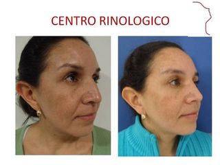 Antes y después de RINOPLASTIA POSTRAUMATICA