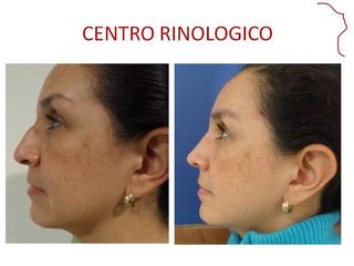 Antes y después de RINOPLASTIA POSTRAUMATICA