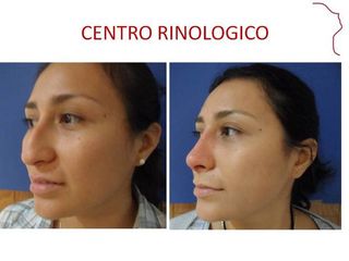 Antes y después de Rinoplastia (acortamiento nasal )