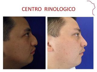 Antes y después de RINOPLASTIA