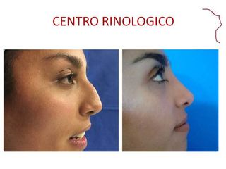 Antes y de RINOPLASTIA.  EVOLUCION 12 MESES