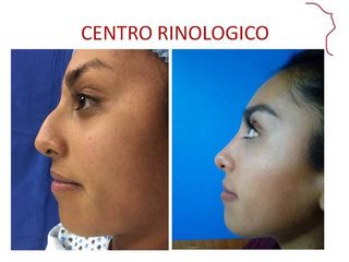 Antes y después de RINOPLASTIA. EVOLUCION 12 MESES