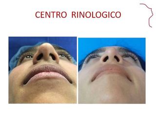 Antes y después de RINOPLASTIA.  EVOLUCION 12 MESES