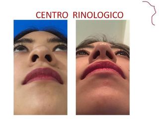 Antes y después de RINOPLASTIA (AFINAMIENTO NASAL)