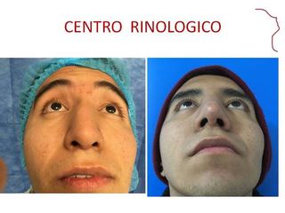 RINOPLASTIA POSTRAUMATICA