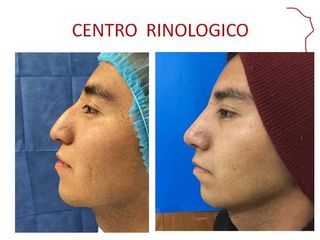 Antes y después de RINOPLASTIA POSTRAUMATICA