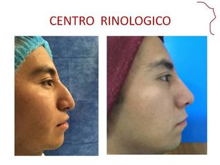 Antes y después de RINOPLASTIA POSTRAUMATICA