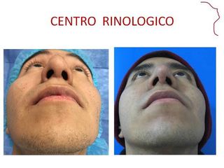 Antes y después de RINOPLASTIA POSTRAUMATICA