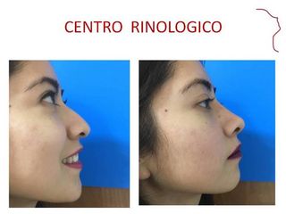 Antes y después de RINOPLASTIA (AFINAMIENTO NASAL)