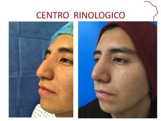 Antes y después de RINOPLASTIA POSTRAUMATICA