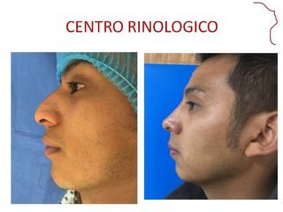 Antes y después de RINOPLASTIA FUNCIONAL 