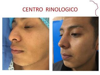 Antes y después de Rinoplastia Funcional