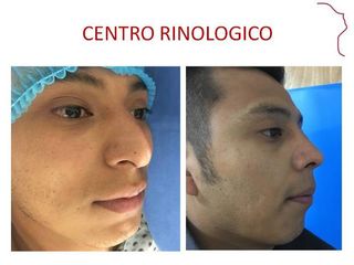 Antes y después de Rinoplastia Funcional