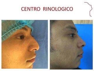 Antes y después de Rinoplastia Funcional