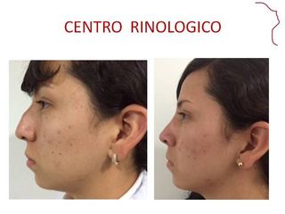 Antes y después de RINOSEPTOPLASTIA FUNCIONAL 