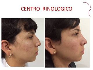 Antes y después de RINOSEPTOPLASTIA FUNCIONAL 