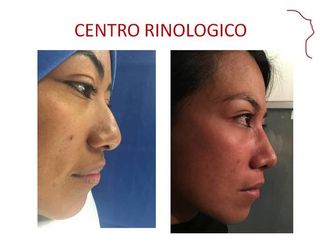 Antes y después de Rinoplastía.  AFINAMIENTO NASAL