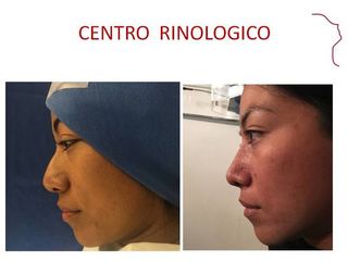 Antes y después de Rinoplastía.  AFINAMIENTO NASAL