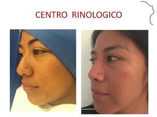 Antes y después de Rinoplastía.  AFINAMIENTO NASAL