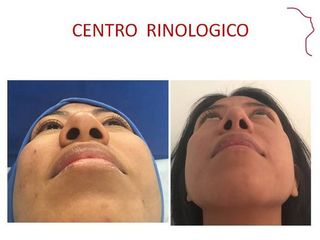 Antes y después de Rinoplastía.  AFINAMIENTO NASAL