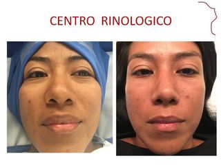 Antes y después de Rinoplastía.  AFINAMIENTO NASAL