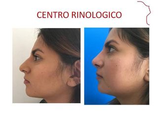 Antes y después de Rinoplastia (acortamiento nasal )