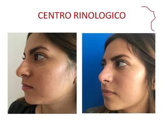 Antes y después de Rinoplastia (acortamiento nasal )