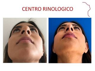 Antes y después de Rinoplastia (acortamiento nasal )