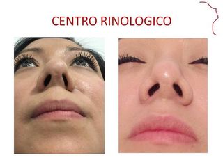 Antes y después de Rinoplastia secundaria.