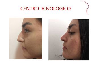 Antes y después de Rinoplastia. Evolucion 12 meses