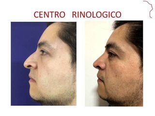 Antes y después de ri Rinoplastia postraumatica 