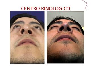 Antes y después de rinoplastía postraumatica 