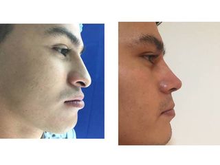 Antes y después de Rinoseptoplastia funcional. Deformidad nasal postraumatica