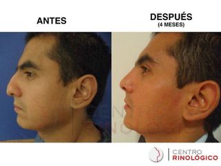 Antes y después de Rinoplastía