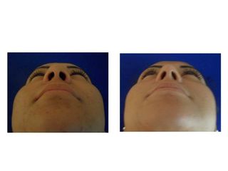 Antes y después de una Rinoplastía