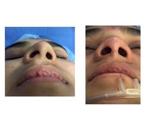 Antes y después la reconstrucción de la base nasal 