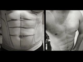 Antes y después de lipoescultura