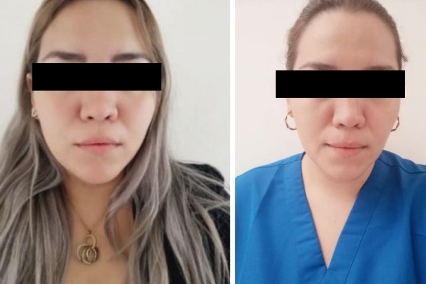 Bolsas de Bichat antes y después - 738413