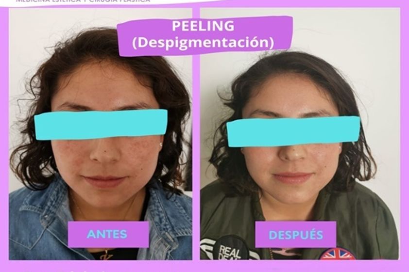 Peeling antes y después - 738715