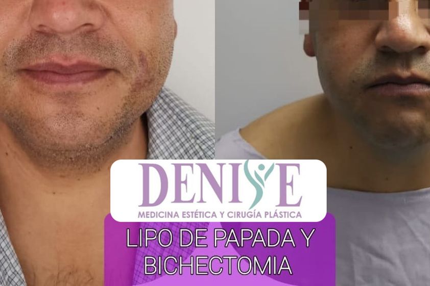 Cirugía de papada antes y después - 796139