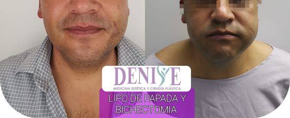Lipopapada + Bichectomia - Clínica Denisse