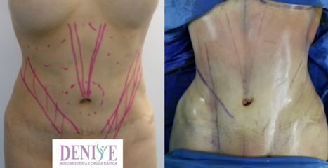 Antes y después de Liposucción - Clínica Denisse