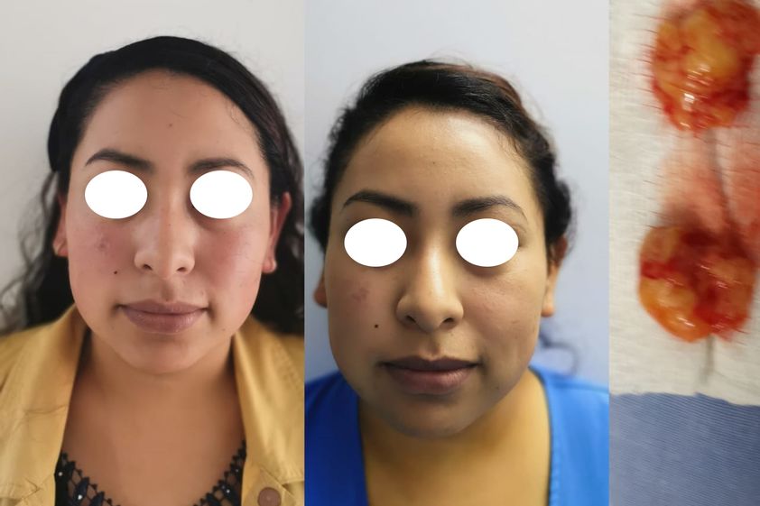 Bolsas de Bichat antes y después - 796142